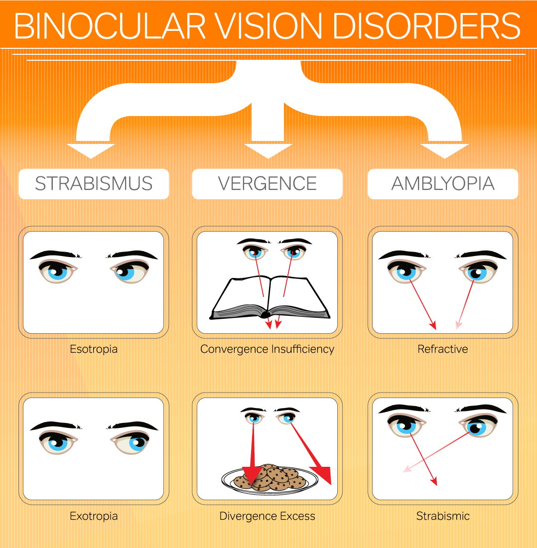 Signs And Symptoms Of Binocular Vision Problems