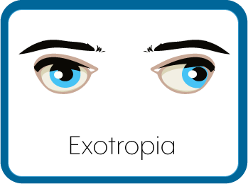 Exotropia